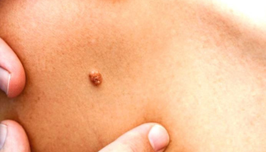 Genital siğil nedir, belirtileri neler