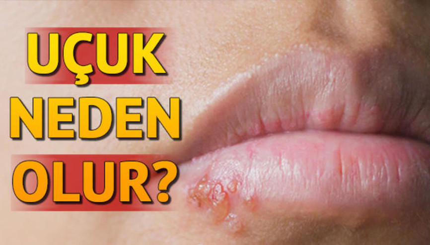Herpes virüsü nedir