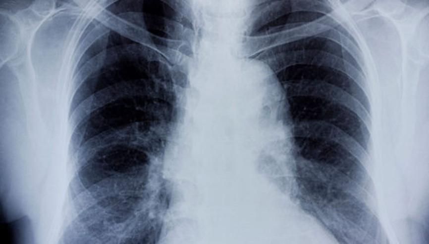 Bronşit nedir Akut bronşit ve kronik bronşitin tanımı Bronşit nedir Akut bronşit ve kronik bronşitin tanımı