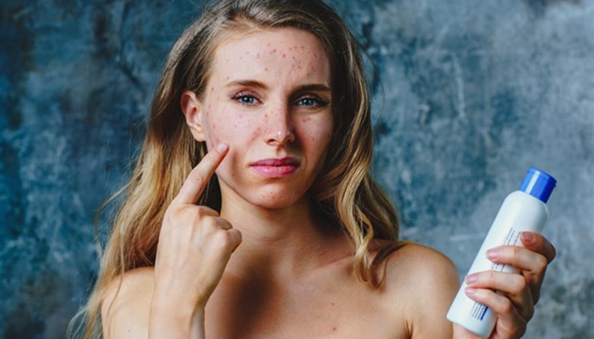 Akneli Yüz Haritası: Çenede, alında, burunda, yanaklarda, kulaklarda, saç çizgisinde ve kaşta sivilce neden çıkar Akneli Yüz Haritası: Çenede, alında, burunda, yanaklarda, kulaklarda, saç çizgisinde ve kaşta sivilce neden çıkar