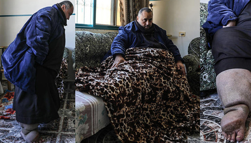 Fil hastalığına yakalanan Filistinli tedavi olacağı günü bekliyor