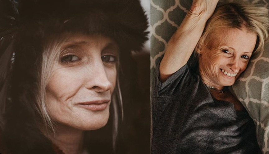 50 milyonda bir rastlanan hastalık yüzünden herkesten sekiz kat hızlı yaşlanıyor