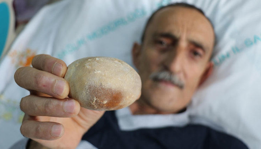 Mesanesinden 522 gramlık tek parça taş çıktı