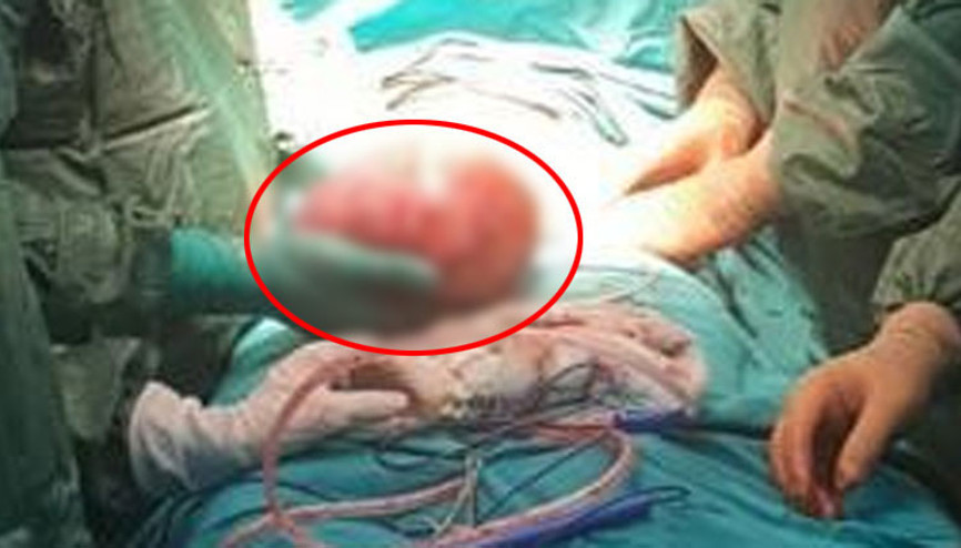 Hastanın karnından 3 kiloluk kist çıktı