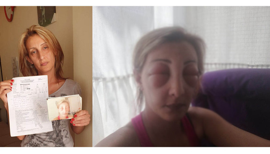 Saçlarını yaptırmak için kuaföre gitti, canından oluyordu Yüzü tanınmayacak hale geldi...