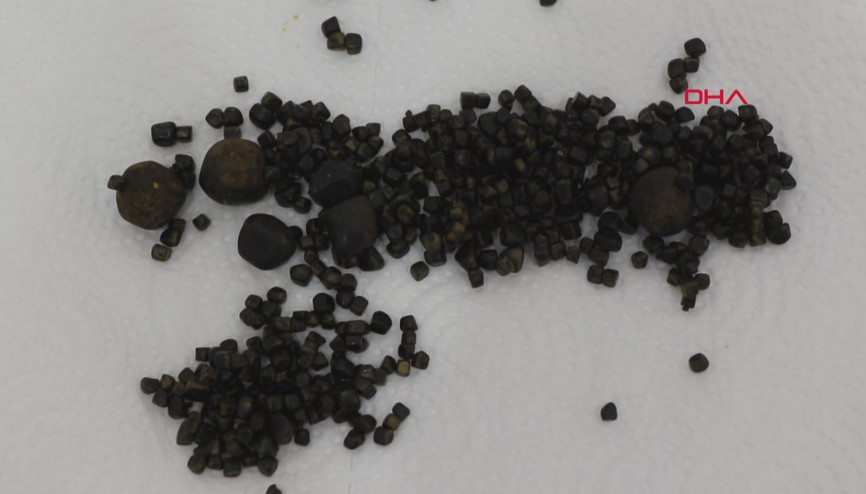 Safra kesesinden 450 adet taş çıktı