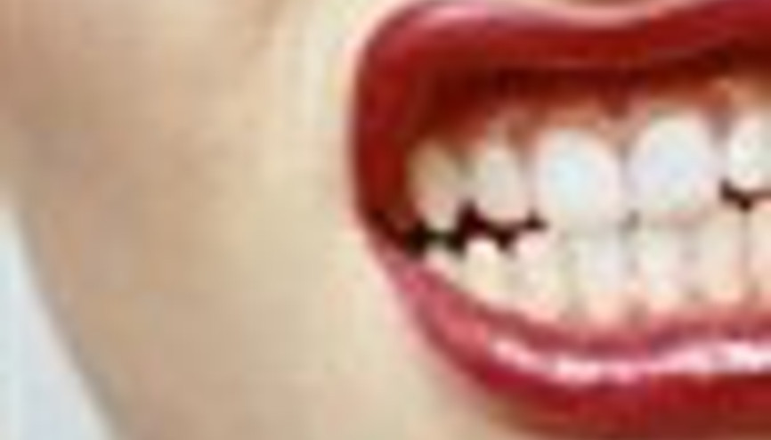 Diş Eksikliği Önemli Mi