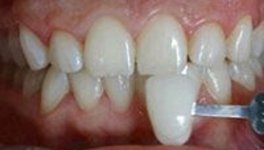 Yaprak porselenlerle dişlerinize doğal güzellik