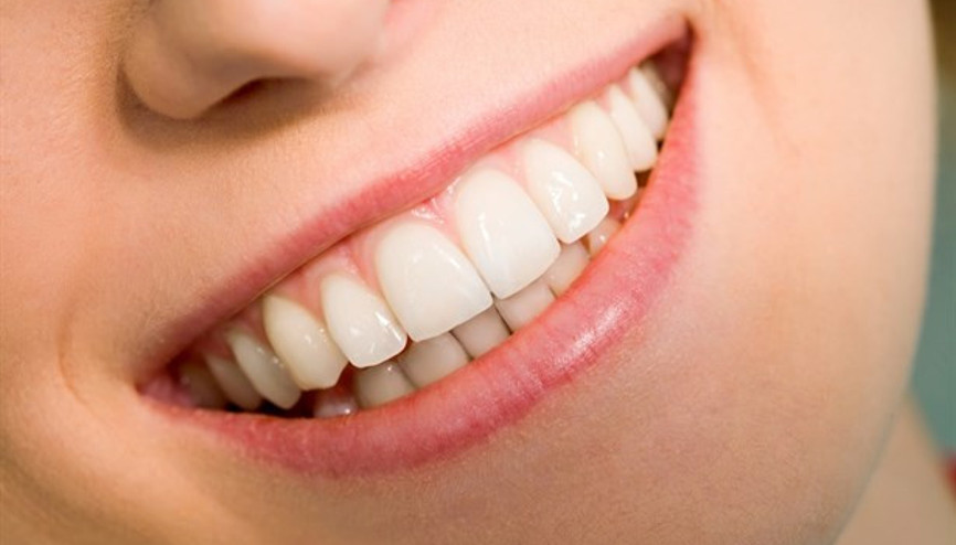 Laminate Veneer İle Doğal Dişler