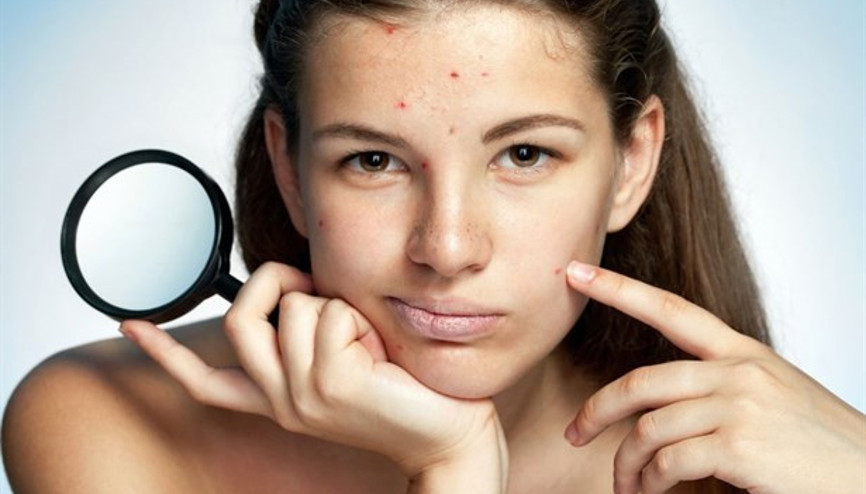 Akne İzleri Kalıcı Olmasın