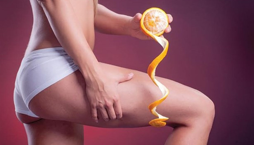 Selülitlerinizin Tedavi Vakti Geldi