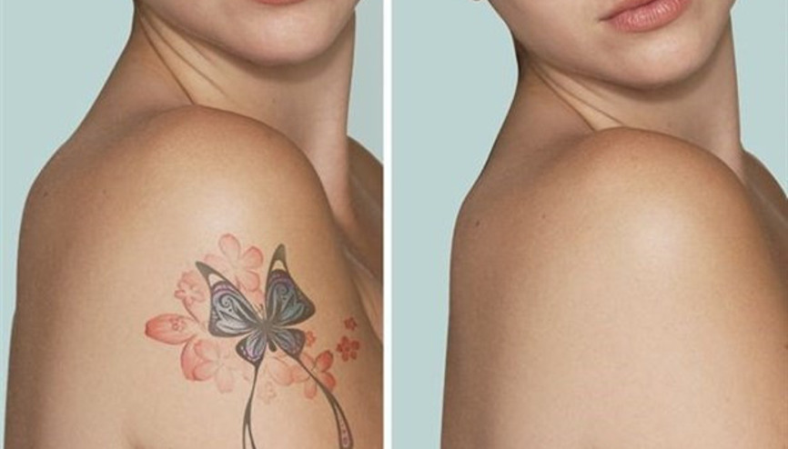 Dövmenizin Modası mı Geçti Silin Gitsin