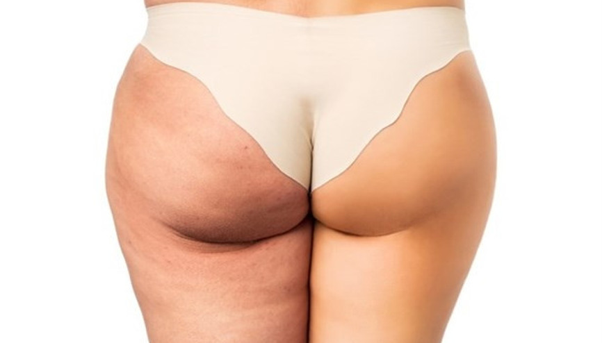 Lipödem Lipedema Nedir & Belirtileri Nelerdir