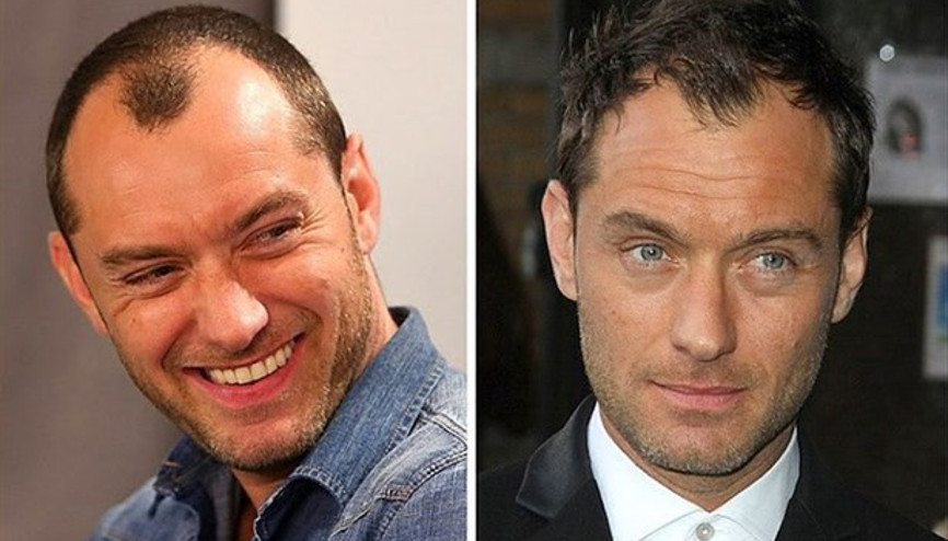 Saç Ekim Sonrası Ne Zaman Denize Girilebilir