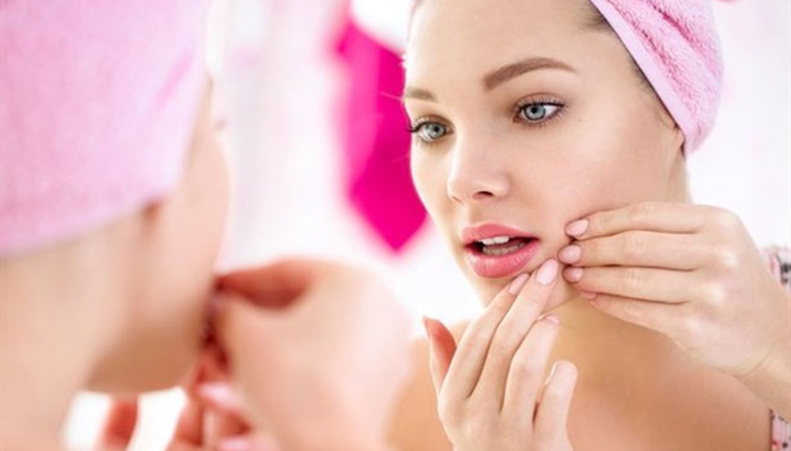 Sivilce İzleriniz İçin Doğal Tedavi Yöntemleri Sivilce İzleriniz İçin Doğal Tedavi Yöntemleri