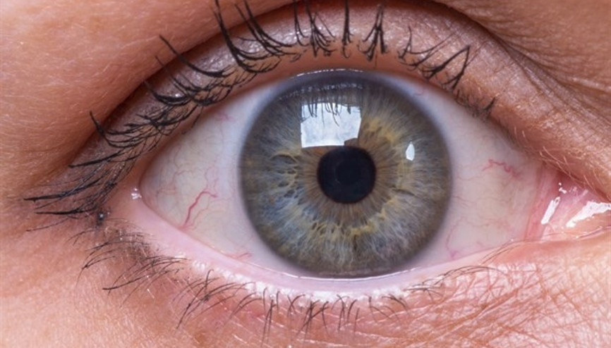 Göz Alerjileri Tedavi Edilmezse Göz Kaybına Neden Olabiliyor