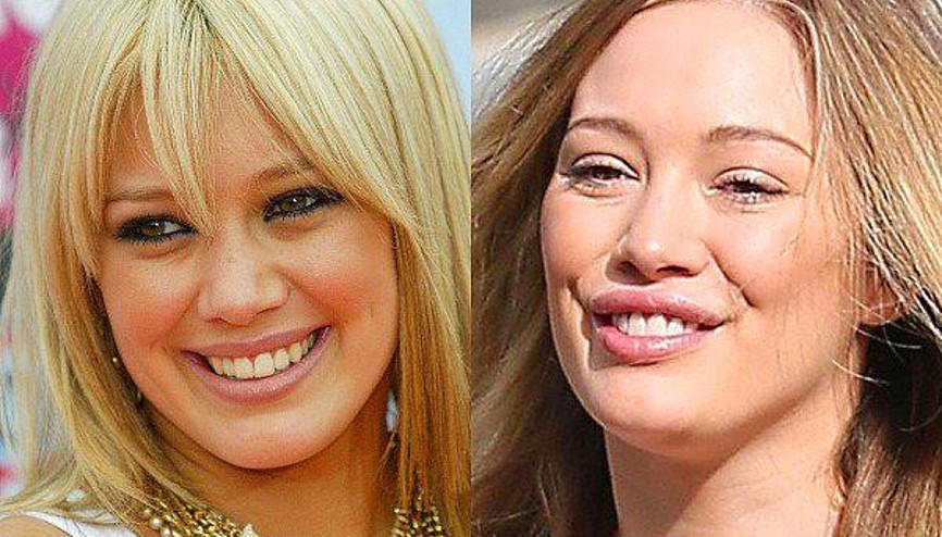 Keşke Estetik Yaptırmasaydı Dediğimiz Ünlüler