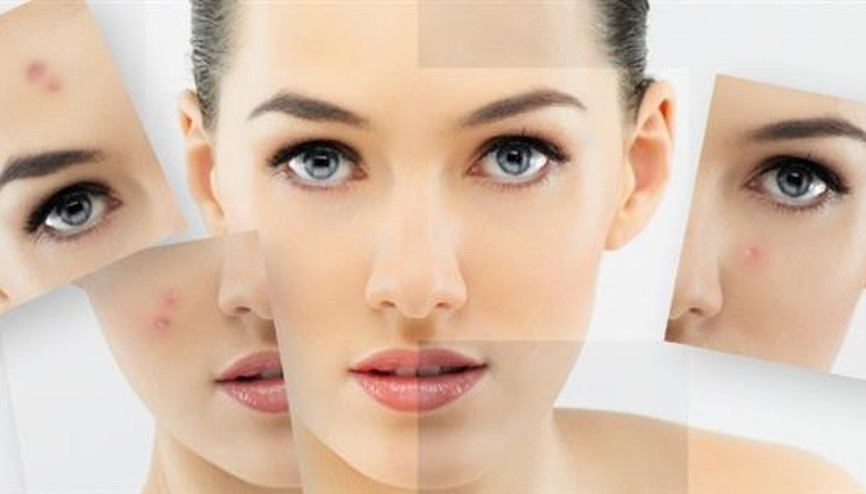 Akneye Yol Açan 10 Neden