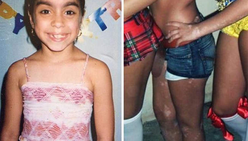 Cilt Hastalığını Sanata Çevirdi