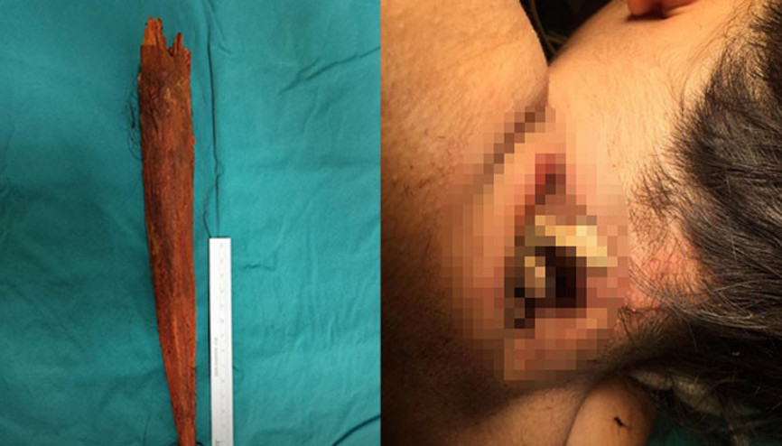 Akılalmaz olay 30 santim uzunluğundaki tahta boynuna saplandı