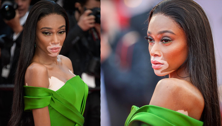 Güzellik Algısını Baştan Yaratan Kadın: Winnie Harlow