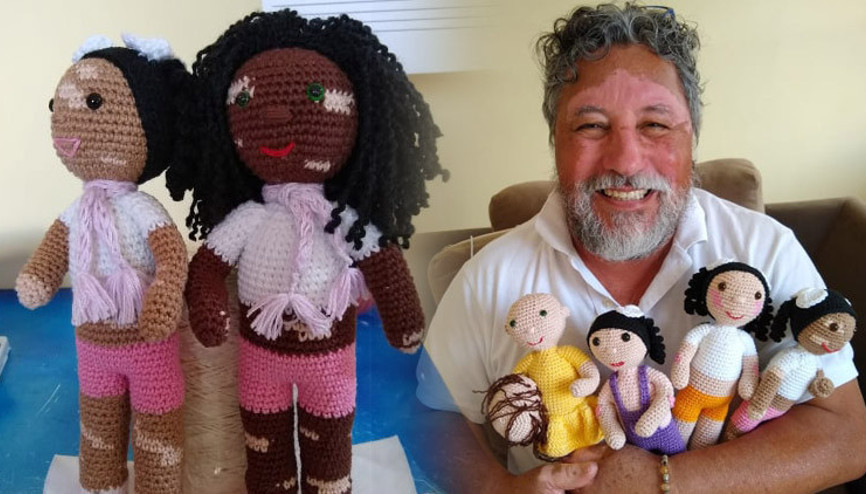 Torunları için başladı, ünü dünyaya yayıldı... Vitiligolu bebekler