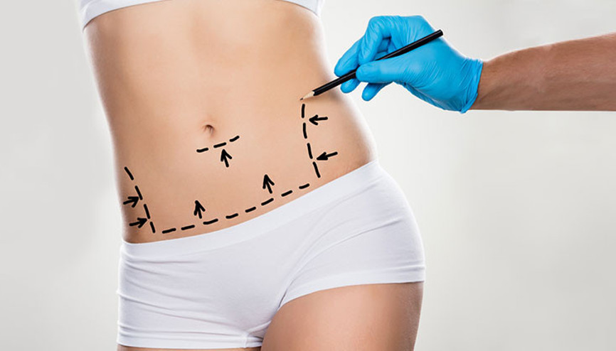 Karın Germe Ameliyatı (Abdominoplasti) Hakkında Merak Edilenler