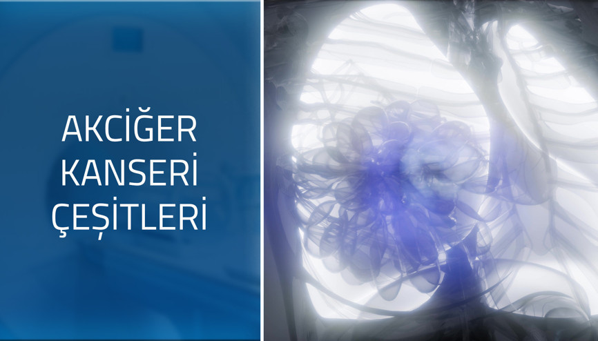 Akciğer kanseri türleri nelerdir Akciğer kanseri türleri nelerdir