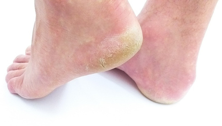 Ayak mantarına ne iyi gelir ve nasıl geçer Ayak mantarı neden olur Evde ayak mantarına iyi gelen bitkisel çözümler ve doğal yöntemler