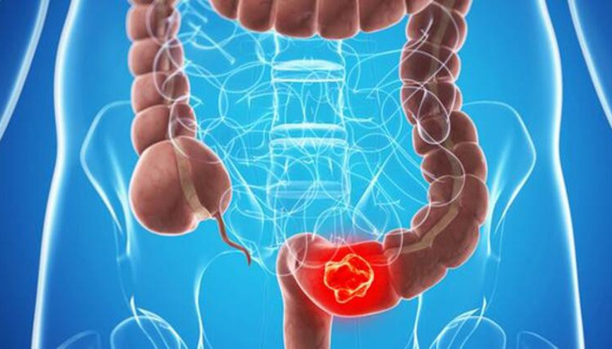 Kolon kanseri nedir, ne kadar sürer Kolon kanseri belirtileri neler