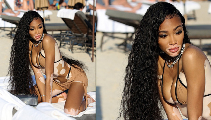 Winnie Harlow: Küçükken alay ederlerdi, şimdi milyon dolarlık servetin sahibi