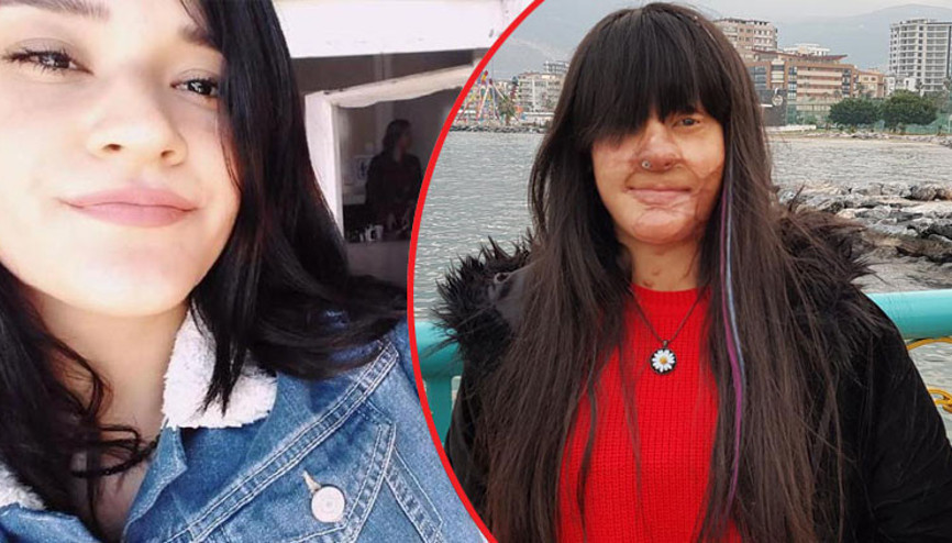 Berfin: Bana eski güzelliğimi verebilecekler mi