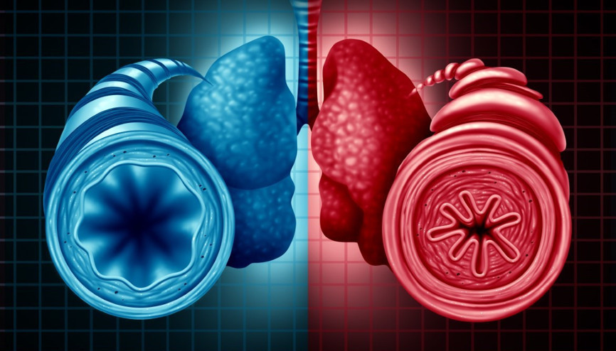 Bronşit belirtileri nelerdir Bronşit nasıl geçer ve ne iyi gelir Bronşit belirtileri nelerdir Bronşit nasıl geçer ve ne iyi gelir