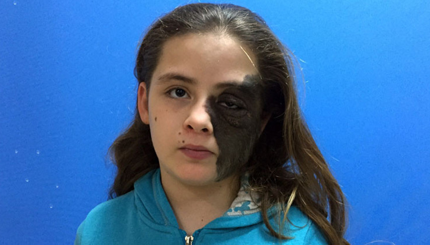 Nazlının yüzü 11 yıl sonra gülecek Yüzünün yarısını kapladı