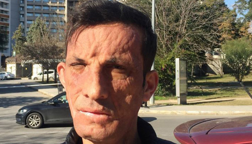 Türkiyenin ilk yüz nakillisi Uğur Acar: Tek isteğim evlenmek