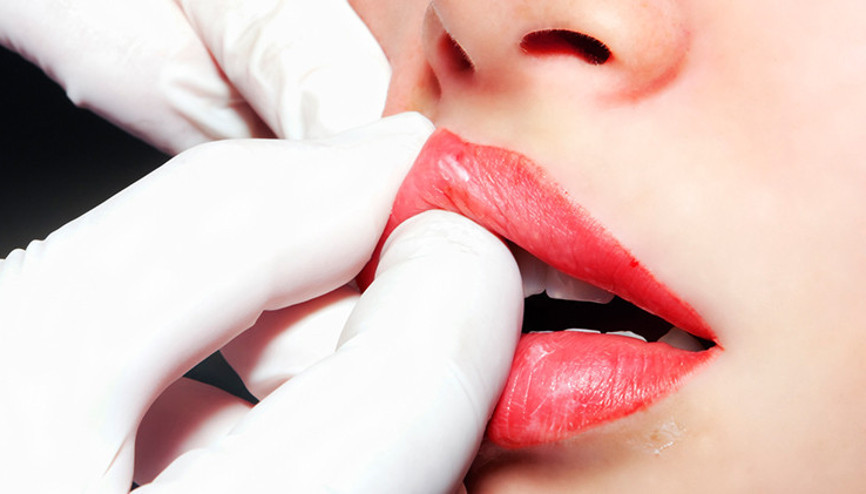 Dudak Dolgusu Yaptırmadan Önce Bilmeniz Gerekenler