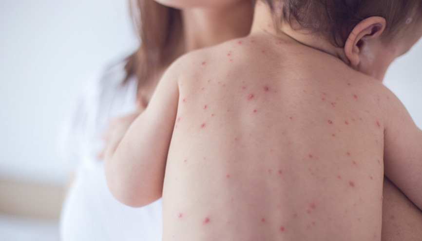 Bu besinler çocuklarda alerjiye neden oluyor