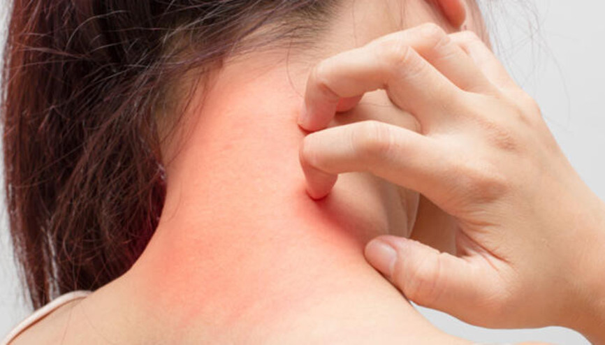 Kurdeşen (ürtiker) nedir Kurdeşen belirtileri neler