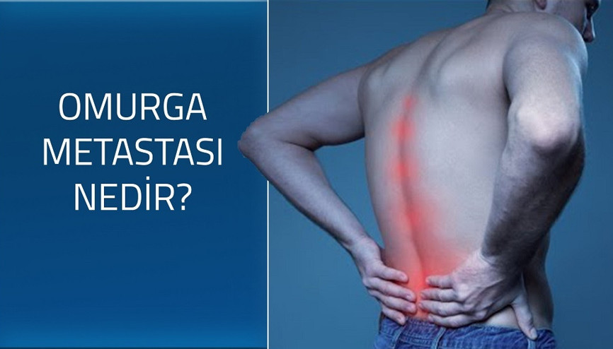 Omurga metastazı nedir