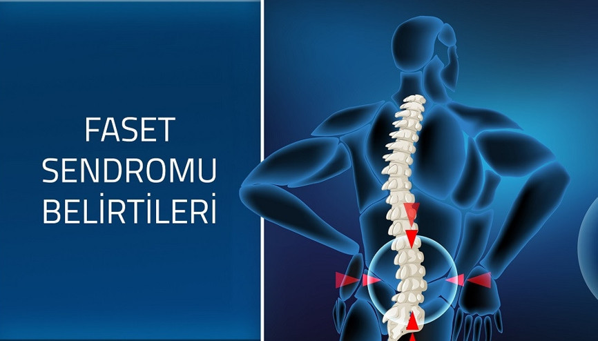 Faset sendromu belirtileri ve tedavisi