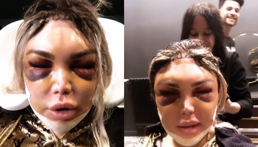 Estetik operasyon sonrası kuaför ziyareti