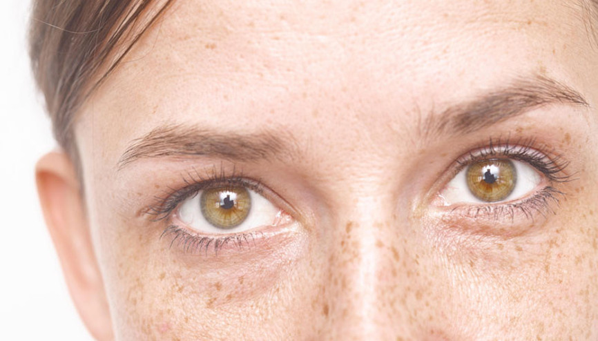 Güneş lekelerine ne iyi gelir, yüzdeki güneş lekeleri nasıl geçer Geçmeyen güneş lekelerine doğal çözüm maske...