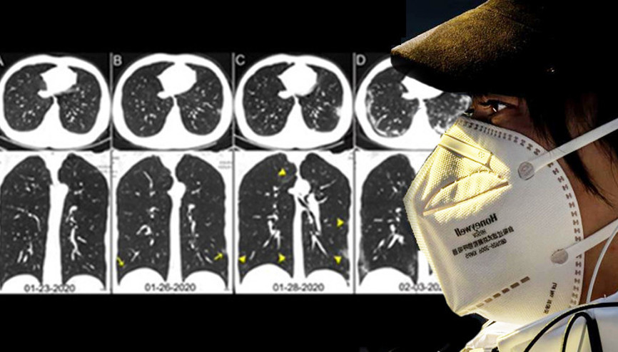 Son dakika haberi: Korkunç gerçeği Corona Virüsünden ölen hastanın röntgeni ortaya çıkardı