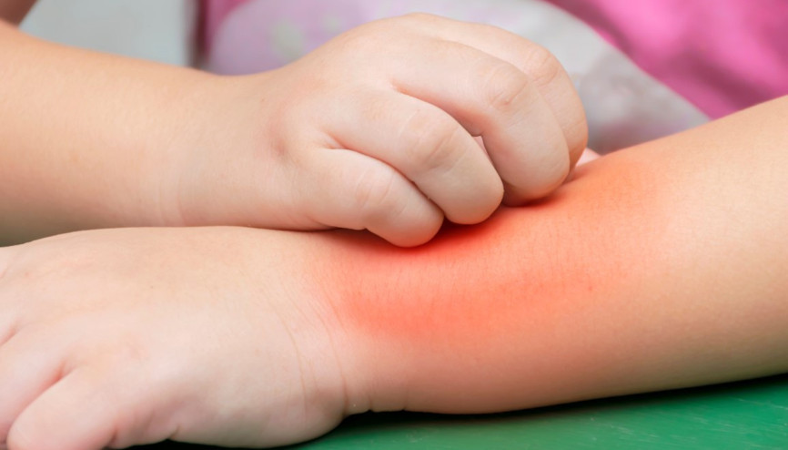 Kurdeşen neden olur, nasıl geçer, bulaşıcı mı Kurdeşene iyi gelen kesin çözüm bitkisel tedavi yöntemleri