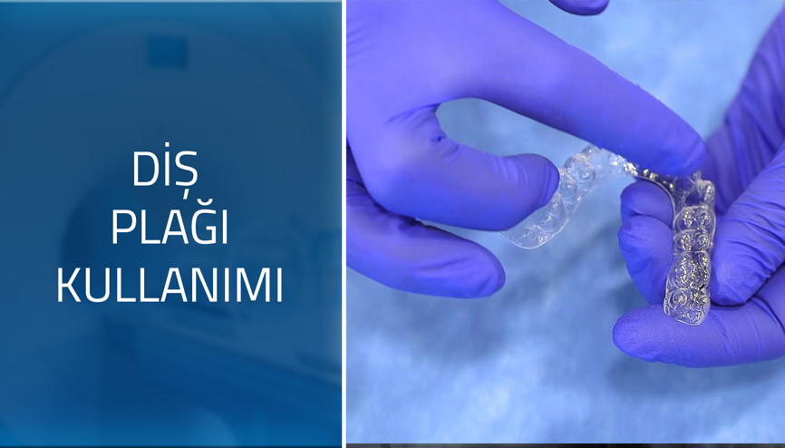 Şeffaf plakların kullanım süresi nedir