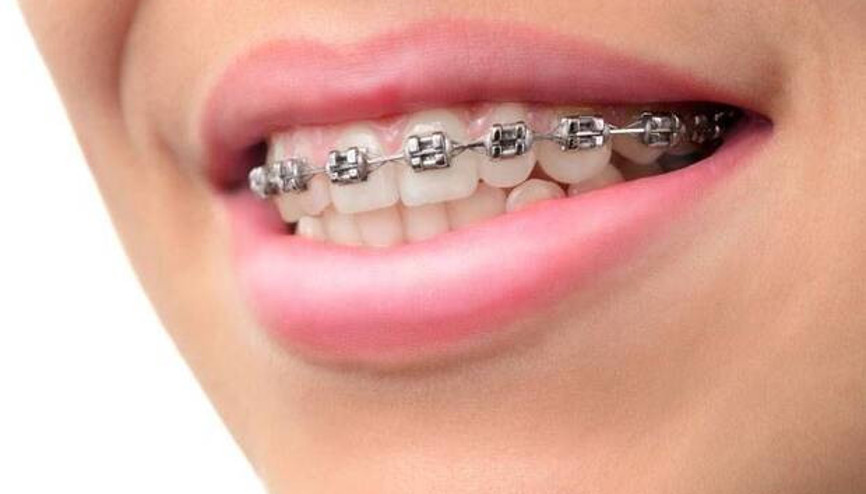 Diş teli hakkında bilinen 10 yanlış