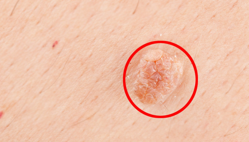 Genital siğil neden olur Belirtileri ve tedavisi Genital siğil neden olur Belirtileri ve tedavisi