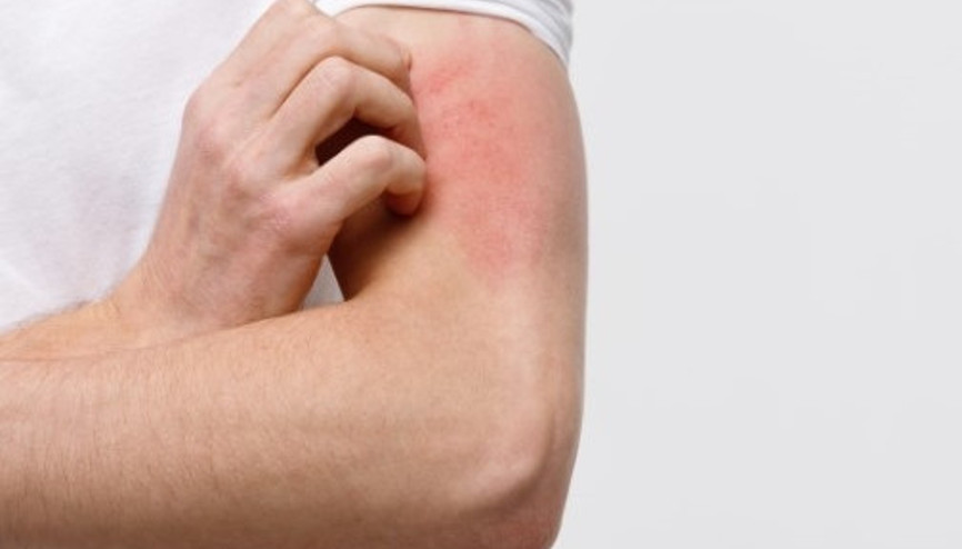 COVID-19 Deri Belirtileri