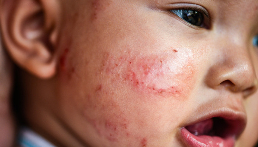 Çocuklarda pandemi sürecinde besin alerjisine dikkat