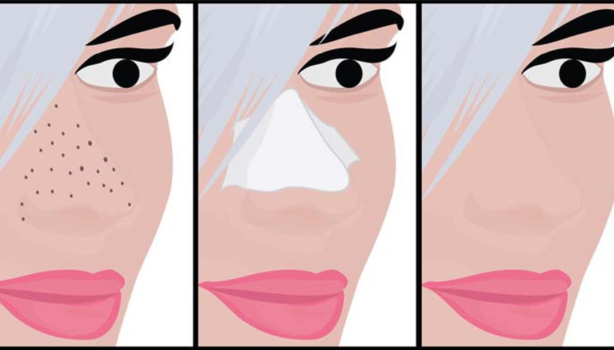 4 Adımda Siyah Noktalardan Kurtulun